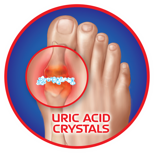 10 Minute Gout Cure: Facts, Figures, and Expert Tips