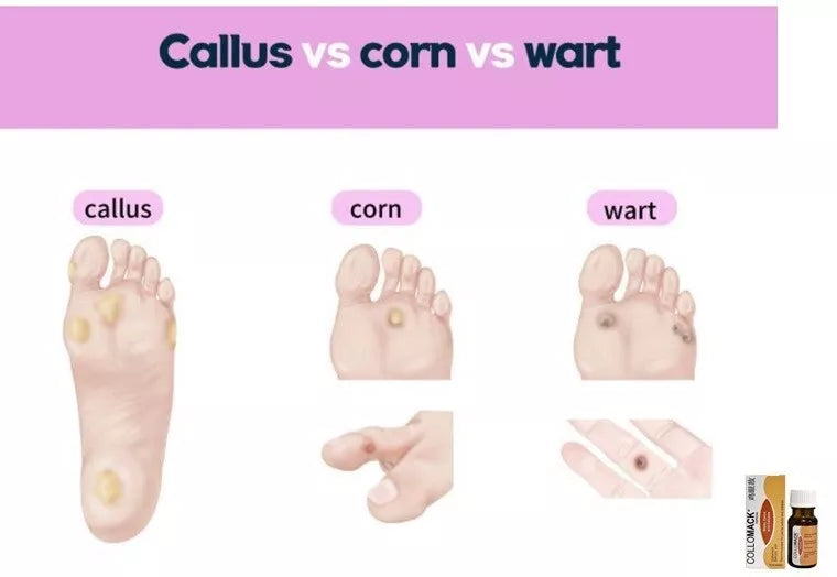 Collomack Topical Plantar Warts Remover 10ml Painless Remover Corns And Calluses