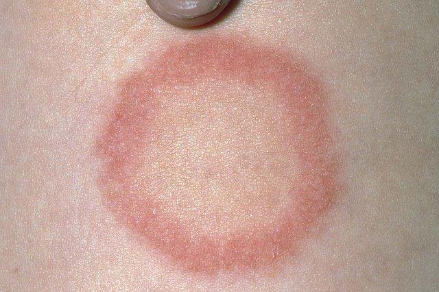Fungal Infection Treatment Creobic Gold Cream 10gm Skin Fungus Itchy Skin - iRFA.COM
