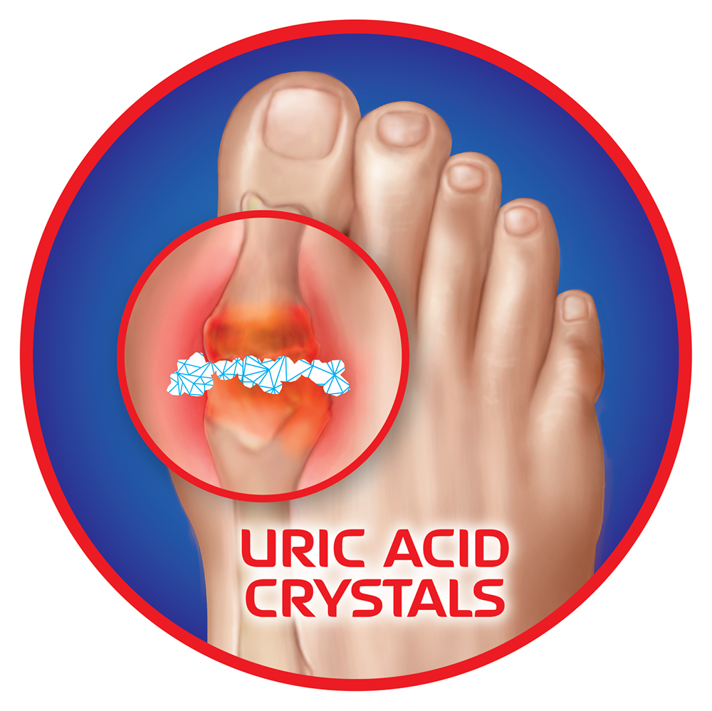 10 Minute Gout Cure: Facts, Figures, and Expert Tips