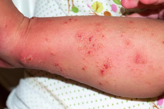 Facts About Benzyl Benzoate Cream You Didn't Know